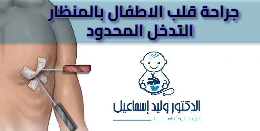 جراحة قلب الاطفال قليلة التوغل والتدخل المحدود 1 عيادة الدكتور وليد اسماعيل - جراحة قلب الاطفال