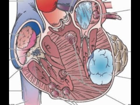 نجاح عملية استئصال ورم عضلي ليفي نادر من قلب طفلة رضيعه تحت اشراف الدكتور وليد اسماعيل 1 عيادة الدكتور وليد اسماعيل - جراحة قلب الاطفال